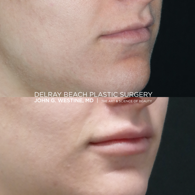 Lip Fillers before and after photo