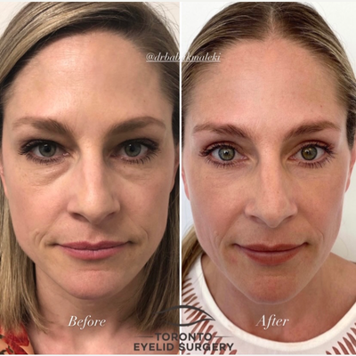 CO2 Laser before and after photo