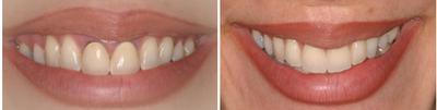 Dental Crown before and after photo