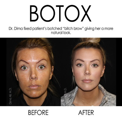 Dysport before and after photo