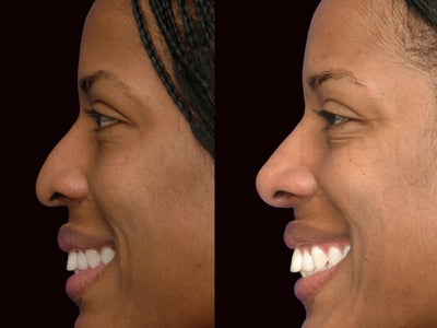 African American Rhinoplasty before and after photo