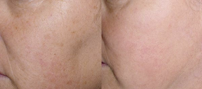IPL before and after photo