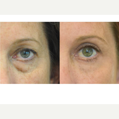 Eyelid Surgery before and after photo