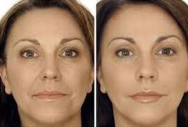 Restylane before and after photo