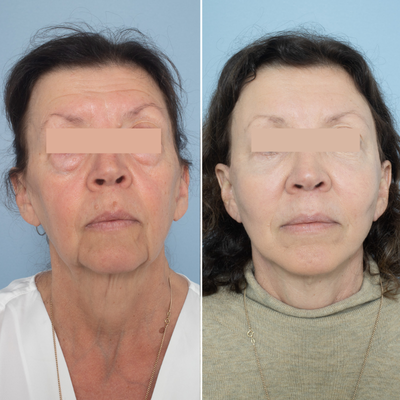 Facelift before and after photo