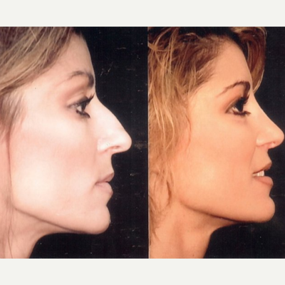Rhinoplasty before and after photo