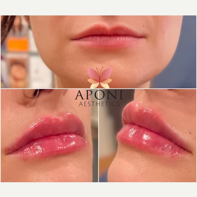 Lip Fillers before and after photo