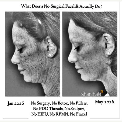 Laser Resurfacing before and after photo