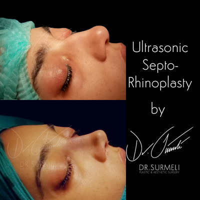 Rhinoplasty before and after photo