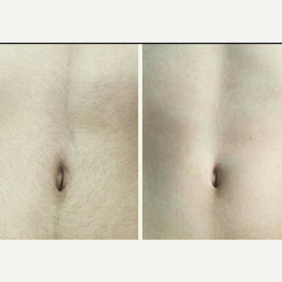 Laser Hair Removal before and after photo