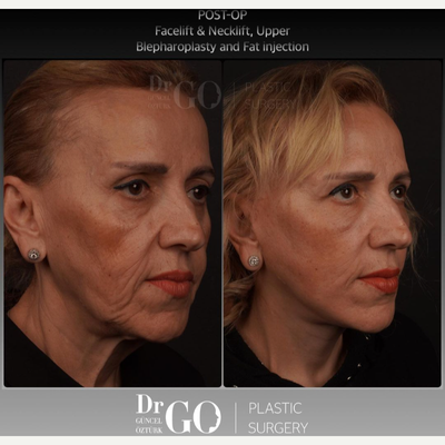 Facelift before and after photo