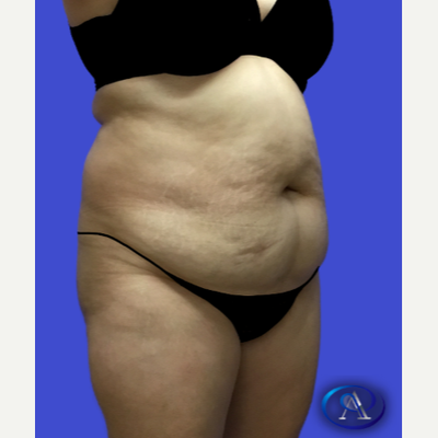Tummy Tuck Before After - Aydin Center for Plastic Surgery