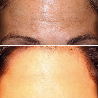 Botox before and after photo