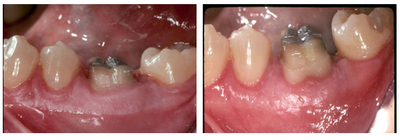 Dental Crown before and after photo