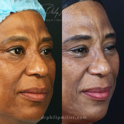African American Rhinoplasty before and after photo
