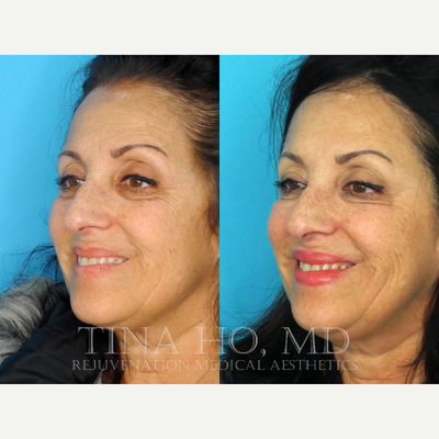 Botox before and after photo
