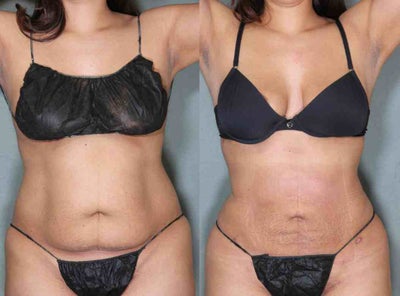 Liposculpture before and after photo