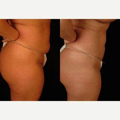 Liposuction before and after photo