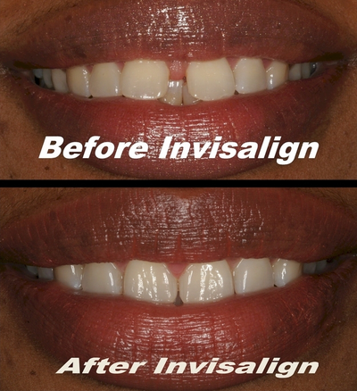 Invisalign before and after photo