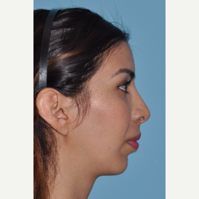 Dr. Richard Zoumalan, Top Nose Job Doctor and Surgeon in CA, Best Natural  Ethnic Rhinoplasty and Septoplasty Surgery LA, Buccal Fat Removal, Chin  Implant, Non-Surgical Facelift and Necklift Specialist with Good Results