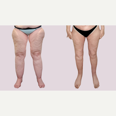 Thigh Lift before and after photo