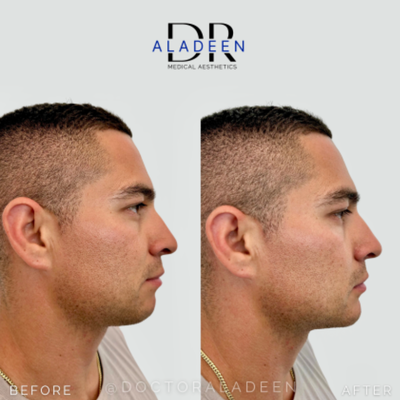 Dermal Fillers before and after photo