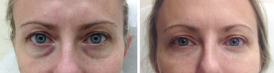 Eyelid Surgery before and after photo