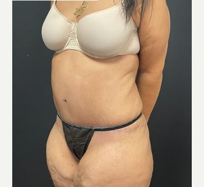 Tummy Tuck before and after photo