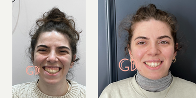 25-34 year old woman treated with Lip Repositioning, Botox for Gummy Smile - Lip repositioning surgery is the most effective method for gummy smile correction. It is usually a permanent procedure and after this surgery you won't need botox for your excessive gum visibility anymore. Lip repositioning surgery not only eliminates gingival visibility, but also reduces the wrinkles of the face and provides botox effect on the face by blocking overactive inner lip muscles. The healing process takes approximately 1 week and it takes approximately 1 month for the results to be fully established.