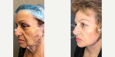 55-64 year old woman treated with Lower Face Lift - Before and after advance Mehr design full face and extended neck lift and upper eyelid surgery, laser and deep chemical skin treatment. 2 weeks post op.