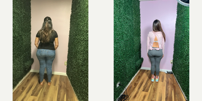 25-34 year old woman treated with Gastric Balloon, Orbera Gastric Balloon - She lost 39 LBS in 10 months after her Orbera Gastric Balloon weight loss procedure.