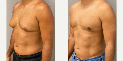 25-34 year old man treated with Gynecomastia Surgery and Liposuction of the abdomen and flanks - 33 yo s/p gynecomastia liposuction with excision and liposuction of the abdomen and flanks performed in our on site AAAA certified operating suite.