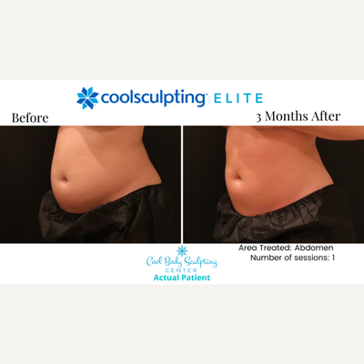 25-34 year old woman treated with CoolSculpting Elite - CoolSculpting before and after in Virginia Beach