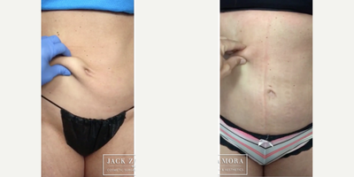 45-54 year old woman treated with Skin Tightening - J-Plazty Body skin tightening treatment, photos illustrate the improvement in skin laxity and firmness.