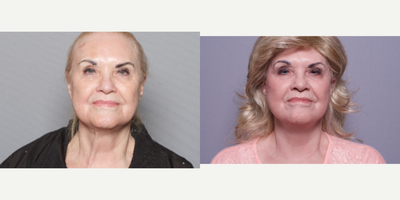 65-74 year old woman treated with Mini Lift - 65-74 year old woman treated with Mini Lift