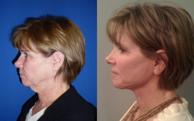 Laser Mini Facelift - 
	Facelift
