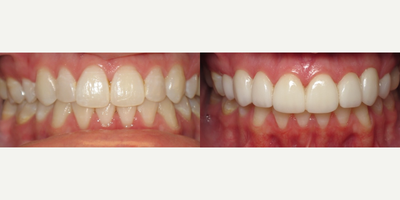 25-34 year old woman treated with Da Vinci Veneers - 10 veneers on upper