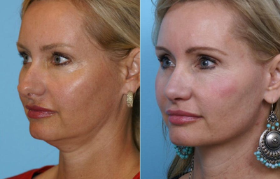 Woman treated with Facelift - This patient was concerned with early signs of aging in her neck and jowl. She had a mini-facelift and lower eyelid skin pinch to bring back her sharp neckline and rejuvenate her eyes.