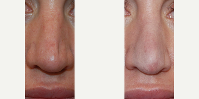 35-44 year old woman treated with Nonsurgical Nose Job, Silikon 1000 - Our beautiful patient came to visit us 3 months after a second failed revision rhinoplasty to correct a left tip indentation. Her after photo is 14 months after her revision rhinoplasty, and after 3 microdroplet Silikon-1000 treatments to permanently fill this indentation. We neither endorse nor offer temporary gel fillers in the nose since occasionally these may lead to necrosis, embolism, blindness, stroke, and biofilm formation. Microdroplet silicone injections have greater than 60 years of safety, precision, and permanence when used for a permanent non-surgical nose job treatment.