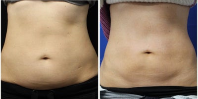 35-44 year old woman treated with CoolSculpting Elite - 35-44 year old woman treated with CoolSculpting Elite