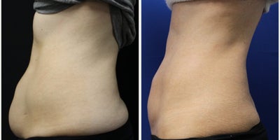 35-44 year old woman treated with CoolSculpting Elite - 35-44 year old woman treated with CoolSculpting Elite