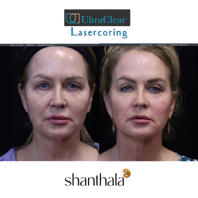 55-64 year old woman treated with Fractional Laser, Laser Resurfacing - Ultraclear lasercoring for around the eyes, around the mouth, full face, full neck, Lasercoring is the cutting edge novel laser-enabled tissue coring & laser-induced deep dermal collagen remodeling which is the future of nonsurgical skin rejuvenation.