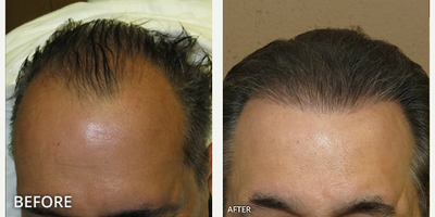 Man treated with Hair Transplant, ARTAS Robotic Hair Transplant - Man treated with Hair Transplant, ARTAS Robotic Hair Transplant