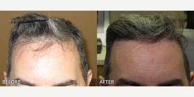 Man treated with Hair Transplant, ARTAS Robotic Hair Transplant - Man treated with Hair Transplant, ARTAS Robotic Hair Transplant