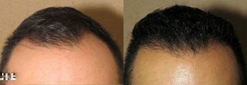 Man treated with Hair Transplant, ARTAS Robotic Hair Transplant - Man treated with Hair Transplant, ARTAS Robotic Hair Transplant