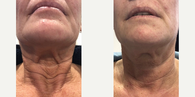 Woman treated with PlasmaPen - Woman treated with PlasmaPen