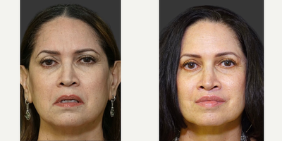 45-54 year old woman treated with Lip Lift, Facial Fat Transfer, Lip Surgery - This patient underwent a lower blepharoplasty (and reinforcing canthopexy), 3D facial fat transfer, lower lip V-Y plasty, medialized corner lip lift and 3D lip lift