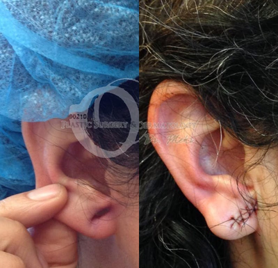 Woman treated with Earlobe Surgery - Woman treated with Earlobe Surgery to close stretched or torn ear lobe