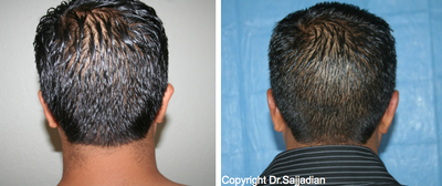 Ear Surgery - Otoplasty