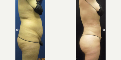 Woman treated with Brazilian Butt Lift - Everyone always wants to know what the long term results are going to be for a fat transfer so this patient is 1 year post op after a BBL and has enough confidence for everyone who sees this.